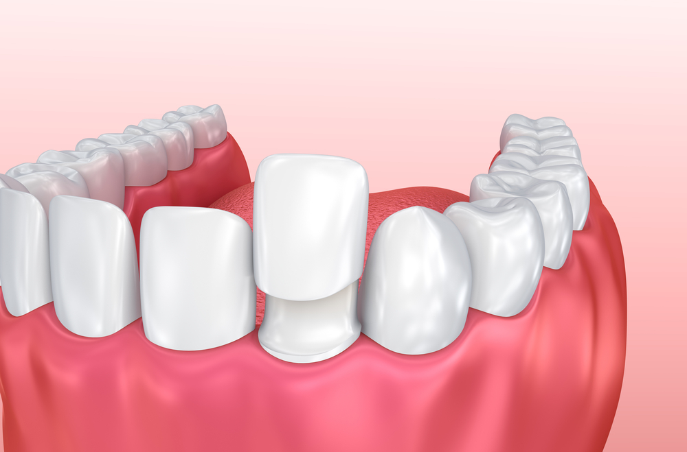 Cosmetic-Composite-Bonding-or-Porcelain-Veneers-Which-Is-Better